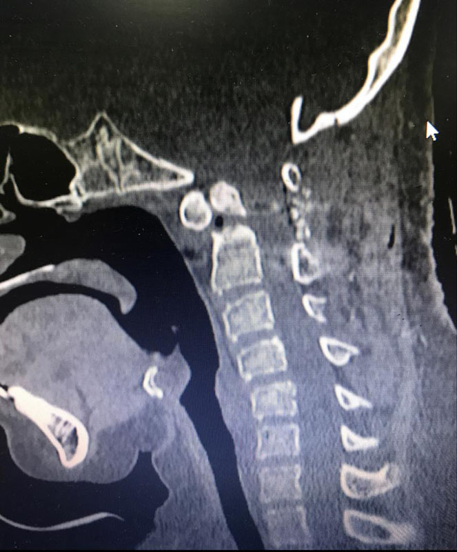 Congenital Spinal Abnormalities