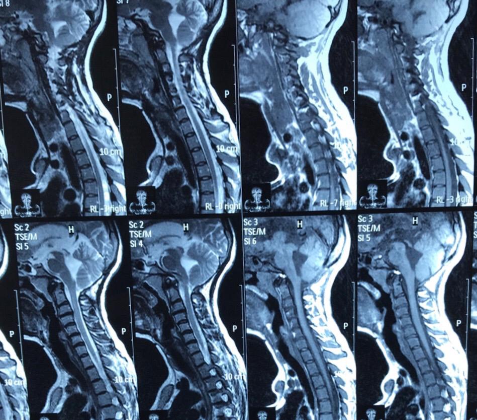 Development Brain Abnormalities