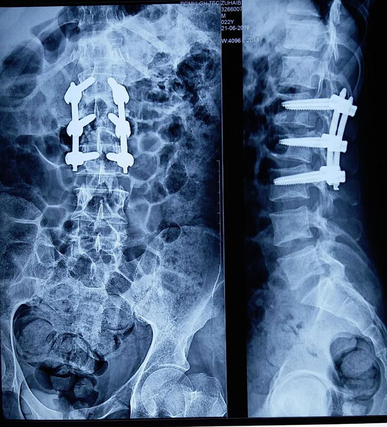 Spinal Injury