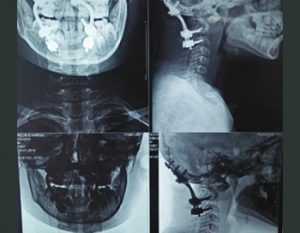 Development Brain Abnormalities