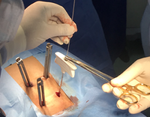 Spinal Tumor Surgery